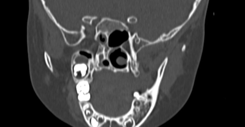 Choanal atresia (Radiopaedia 51295-56972 Coronal bone window 71).jpg