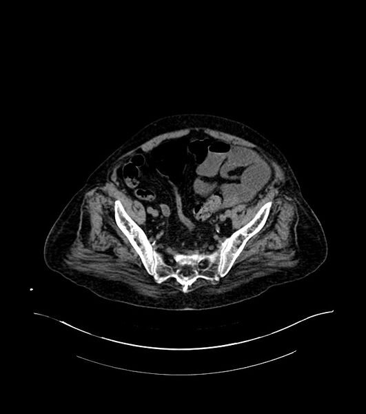 File:Cholangiocarcinoma with cerebral metastases (Radiopaedia 83519-98629 Axial non-contrast 102).jpg