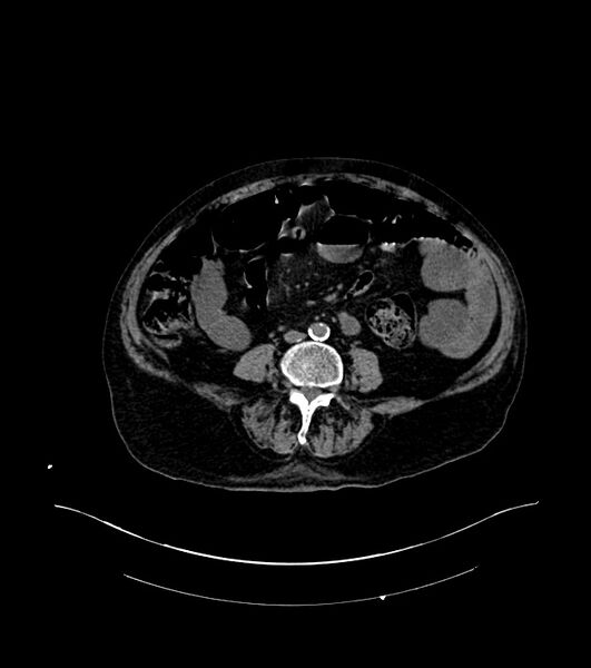 File:Cholangiocarcinoma with cerebral metastases (Radiopaedia 83519-98629 Axial non-contrast 72).jpg