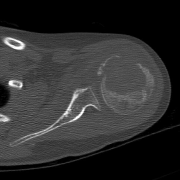 File:Chondroblastoma (Radiopaedia 8437-9263 Axial bone window 1).jpg