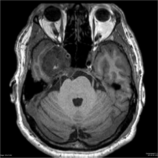 File:Chondrosarcoma of skull base- grade II (Radiopaedia 40948-43654 Axial T1 38).jpg