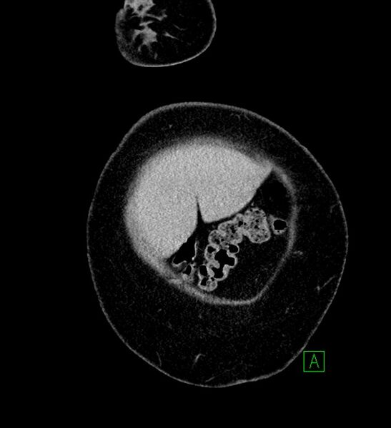 File:Chromophobe renal cell carcinoma (Radiopaedia 84239-99519 F 7).jpg