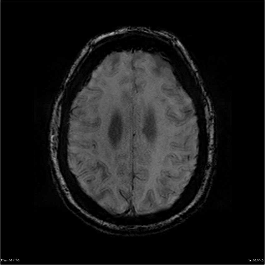 Chronic hypertensive encephalopathy (Radiopaedia 25764-25918 Axial SWI 39).jpg