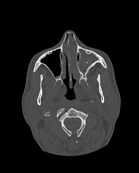 File:Chronic maxillary sinusitis caused by a foreign body (Radiopaedia 58521-65676 Axial bone window 111).jpg