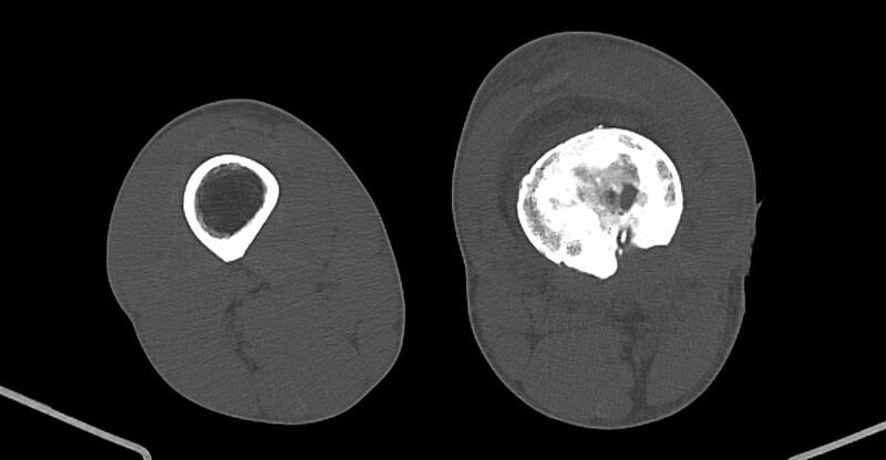 File:Chronic osteomyelitis (with sequestrum) (Radiopaedia 74813-85822 Axial non-contrast 145).jpg