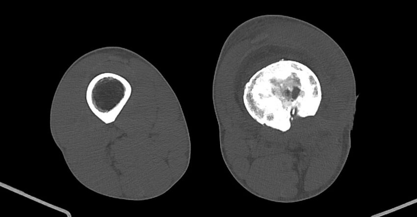 Chronic osteomyelitis (with sequestrum) (Radiopaedia 74813-85822 Axial non-contrast 145).jpg