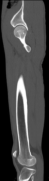File:Chronic osteomyelitis (with sequestrum) (Radiopaedia 74813-85822 C 28).jpg