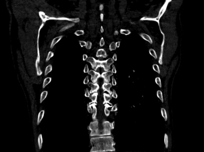 File:Chronic pulmonary embolism (Radiopaedia 91241-108843 A 98).jpg