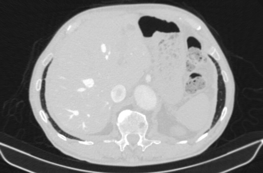 Chronic pulmonary embolism (Radiopaedia 91241-108843 Axial lung window 90).jpg