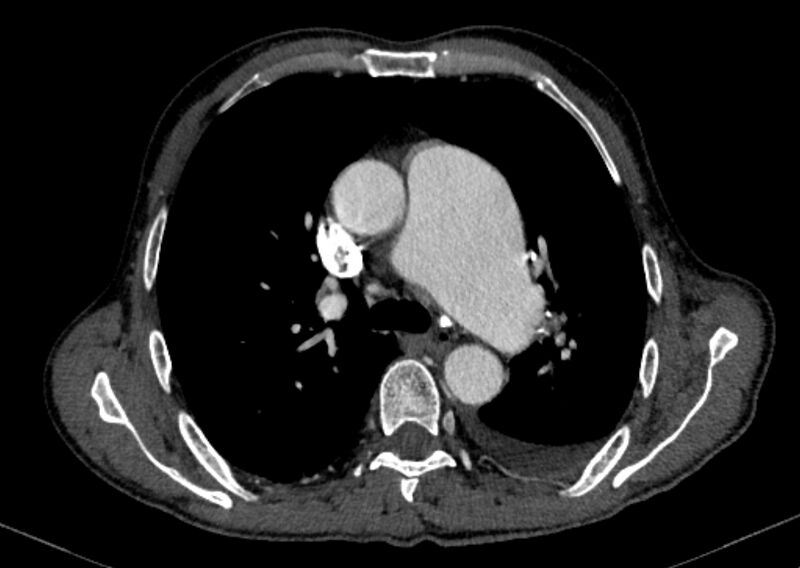 File:Chronic pulmonary embolism with bubbly consolidation (Radiopaedia 91248-108850 C+ arterial phase 57).jpg