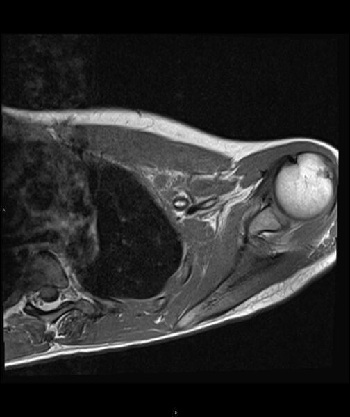 File:Chronic reactive multifocal osteomyelitis (CRMO) - clavicle (Radiopaedia 56406-63071 Axial T1 15).jpg