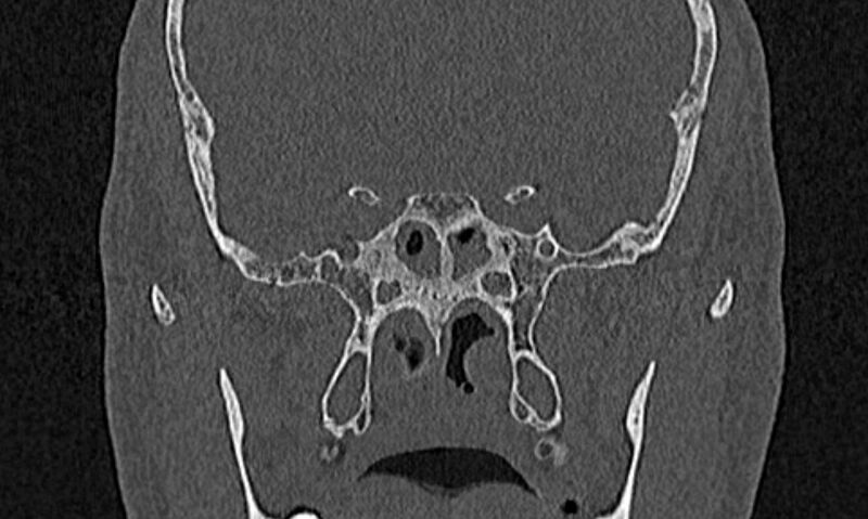 File:Chronic rhinosinusitis (Radiopaedia 65079-74075 Coronal bone window 67).jpg