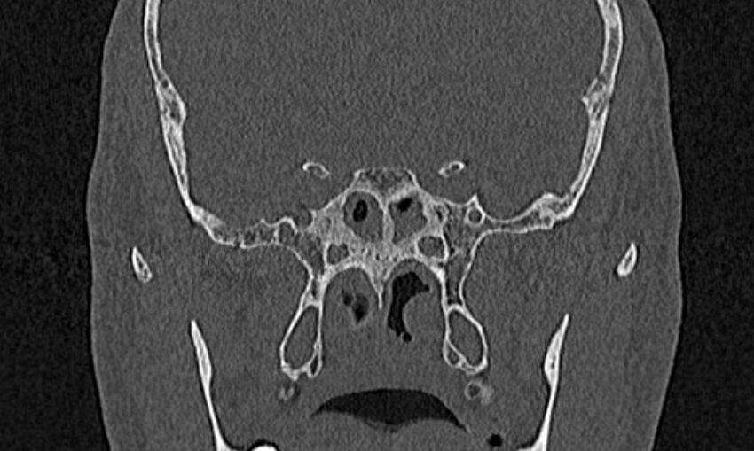 Chronic rhinosinusitis (Radiopaedia 65079-74075 Coronal bone window 67).jpg