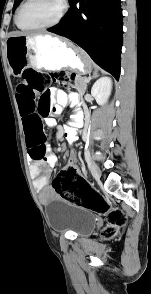 File:Chronic small bowel volvulus (Radiopaedia 75224-86322 C 59).jpg