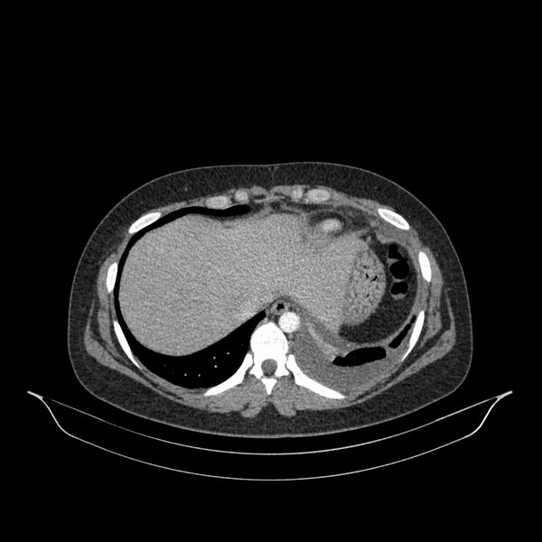 File:Chronic thromboembolic pulmonary hypertension (CTEPH) (Radiopaedia 74597-85532 Axial C+ CTPA 33).jpg
