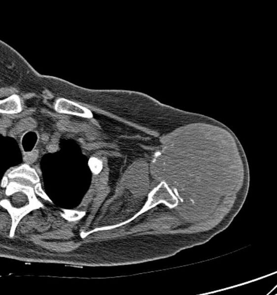 File:Clear cell chondrosarcoma - humerus (Radiopaedia 63104-71612 Axial non-contrast 33).jpg