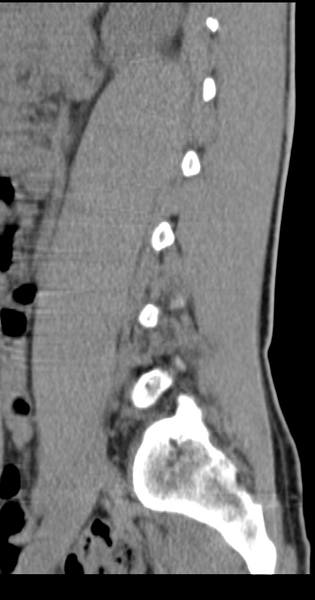 File:Clear cell meningoma - lumbar spine (Radiopaedia 60116-67691 A 12).png