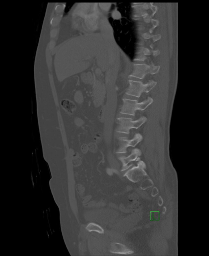 Clear cell renal cell carcinoma (Radiopaedia 85006-100539 Sagittal bone window 35).jpg