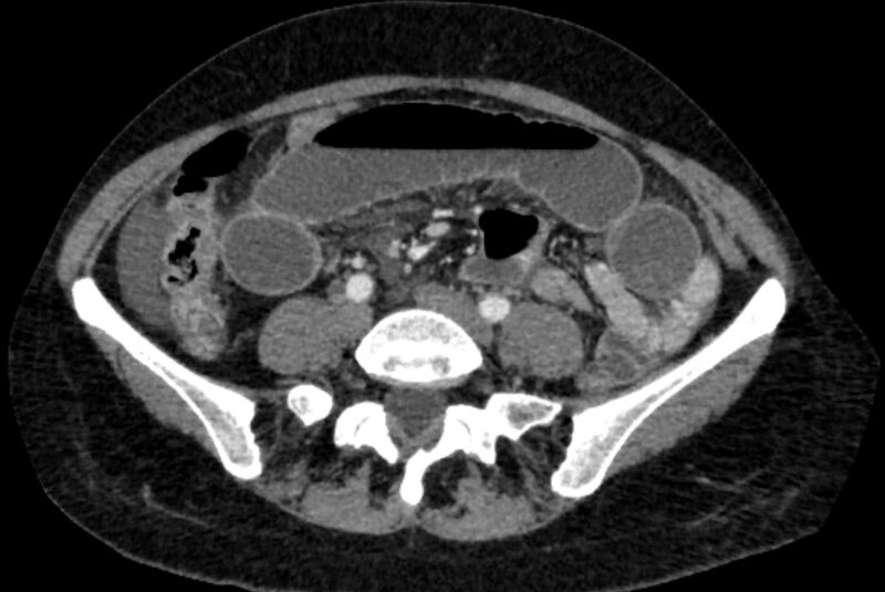 File:Closed loop small bowel obstruction (Radiopaedia 71211-81508 A 89).jpg
