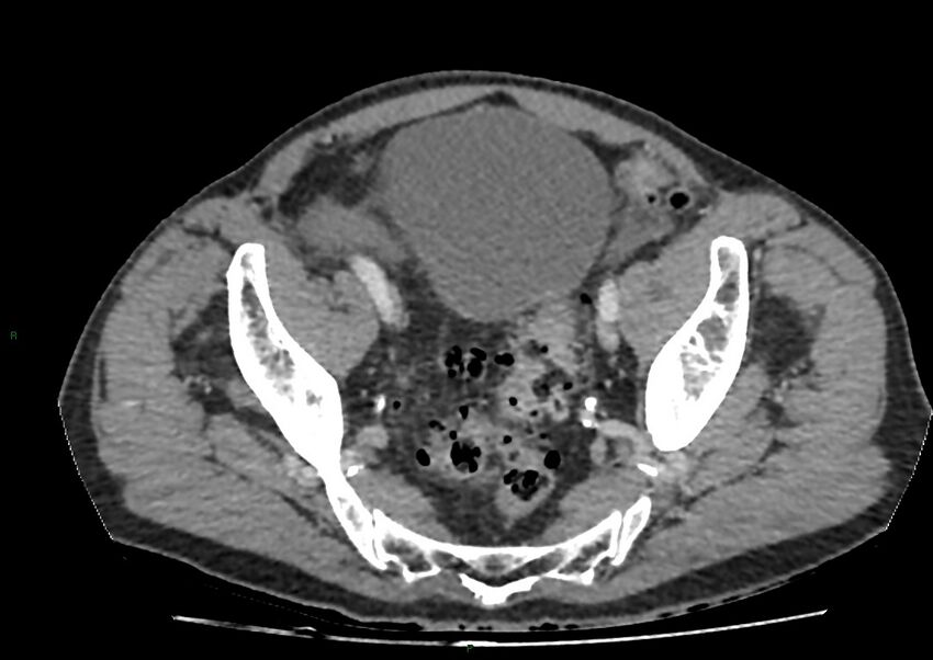 Closed loop small bowel obstruction with ischemia (Radiopaedia 84180-99456 A 100).jpg