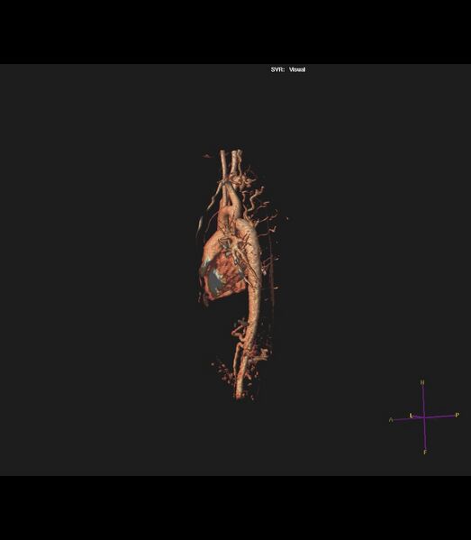 File:Coarctation of the aorta (Radiopaedia 43373-46729 3D reconstruction 13).jpg