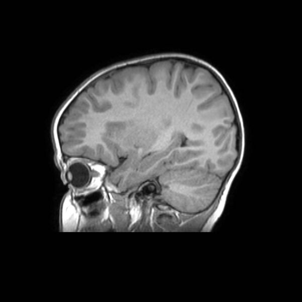 File:Cochlear nerve aplasia - unilateral (Radiopaedia 87910-104413 Sagittal T1 33).jpg