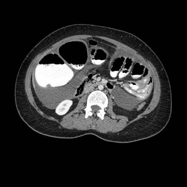 File:Cocoon abdomen with possible tubo-ovarian abscess (Radiopaedia 46235-50636 A 20).png