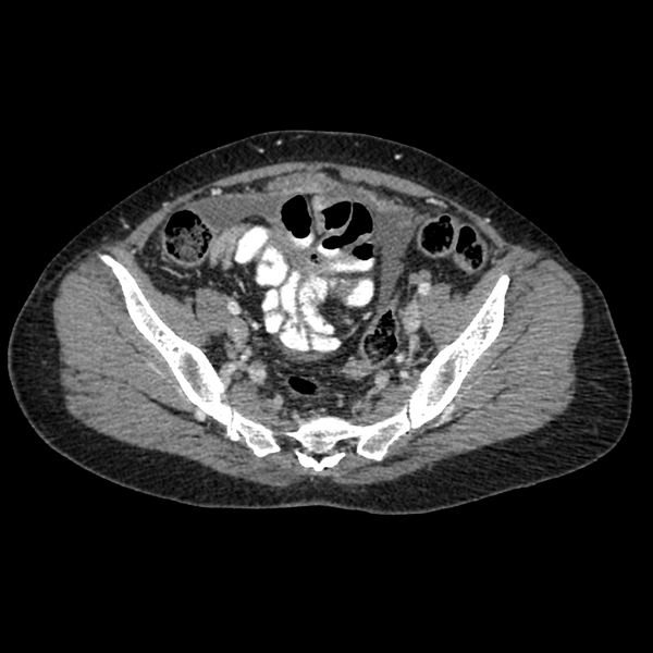 File:Cocoon abdomen with possible tubo-ovarian abscess (Radiopaedia 46235-50636 A 36).png
