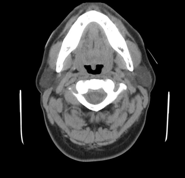 File:Colloid cyst of thyroid (Radiopaedia 22897-22923 Axial non-contrast 16).jpg