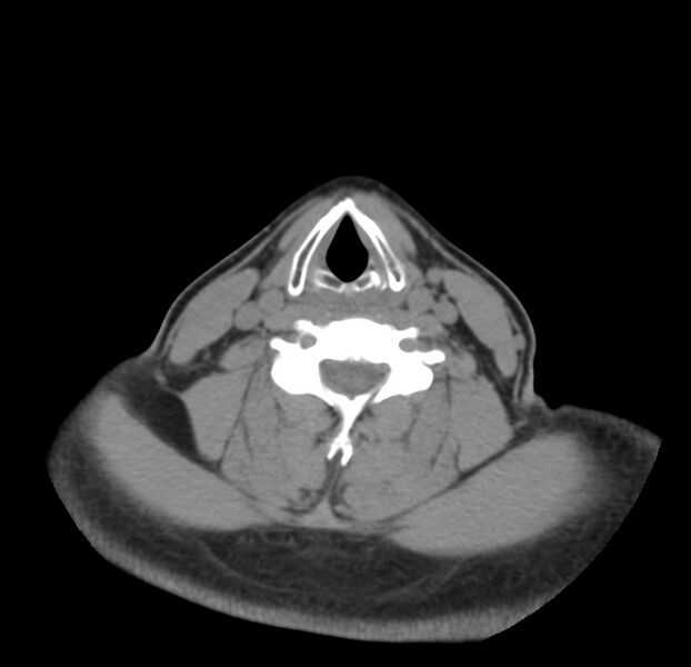 File:Colloid cyst of thyroid (Radiopaedia 22897-22923 Axial non-contrast 33).jpg