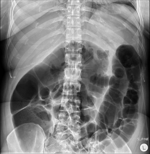 File:Colonic pseudo-obstruction (Radiopaedia 79752-92976 Frontal 1).png