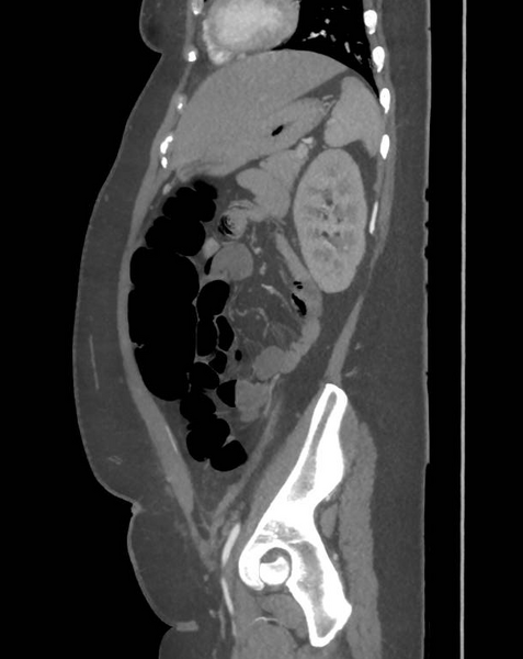 File:Colonic pseudo-obstruction (Radiopaedia 79752-92980 C 55).png