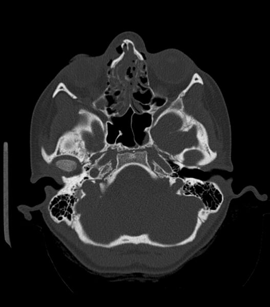 File:Nasoorbitoethmoid fracture (Radiopaedia 90044-107205 Axial bone window 75).jpg