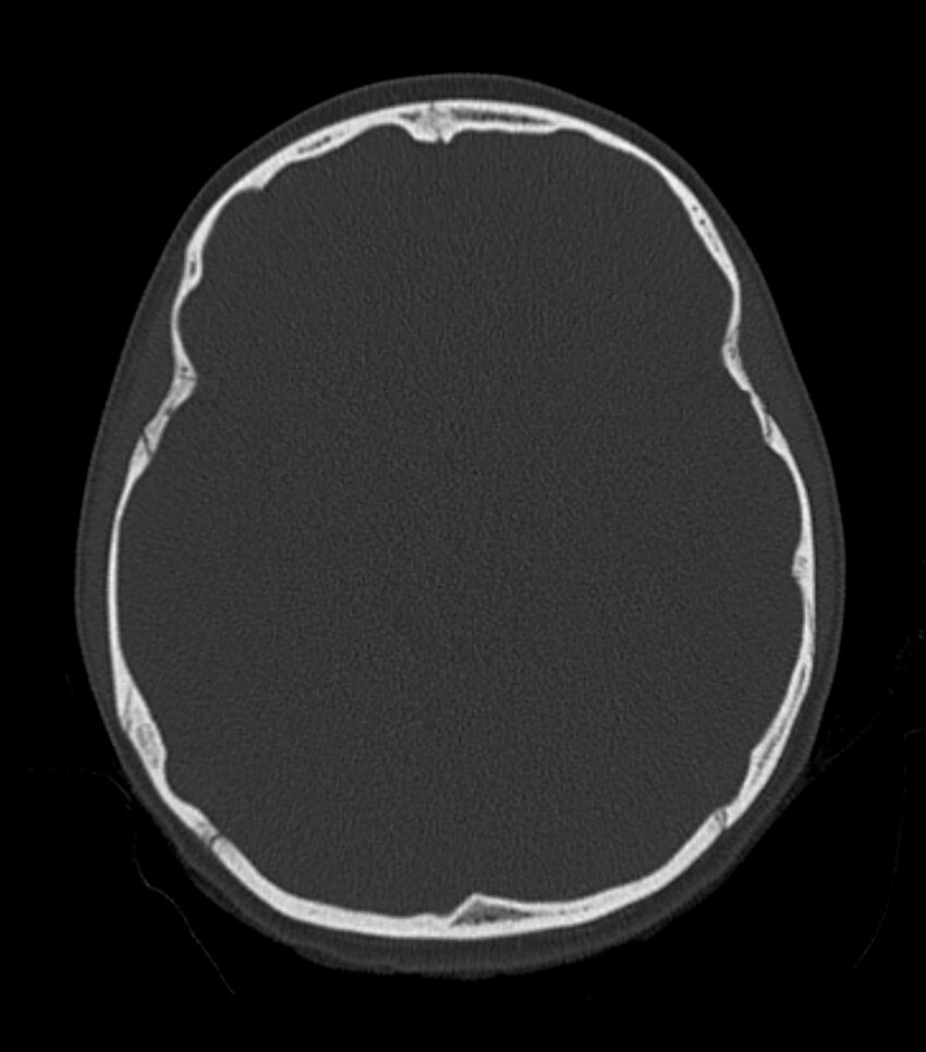 Nasoorbitoethmoid fracture (Radiopaedia 90044-107205 Axial bone window 99).jpg