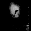 Neonatal neuroblastoma (Radiopaedia 56651-63438 Coronal non-contrast 4).jpg