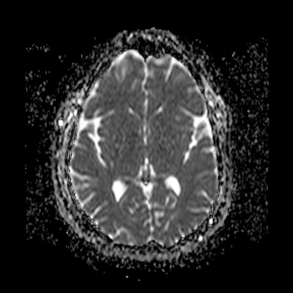File:Neurofibromatosis type 2 (Radiopaedia 67470-76871 Axial ADC 12).jpg