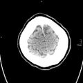 Neurotoxoplasmosis - concentric target sign (Radiopaedia 70644-80783 Axial non-contrast 36).jpg