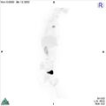 Non-Hodgkin lymphoma involving seminal vesicles with development of interstitial pneumonitis during Rituximab therapy (Radiopaedia 32703-33752 PET cor 3D MIP 10).jpg