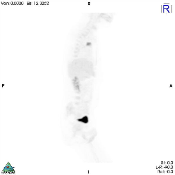 File:Non-Hodgkin lymphoma involving seminal vesicles with development of interstitial pneumonitis during Rituximab therapy (Radiopaedia 32703-33752 PET cor 3D MIP 10).jpg
