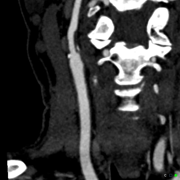File:Non-occlusive intraluminal internal carotid artery thrombus (Radiopaedia 37751-39658 C 38).jpg
