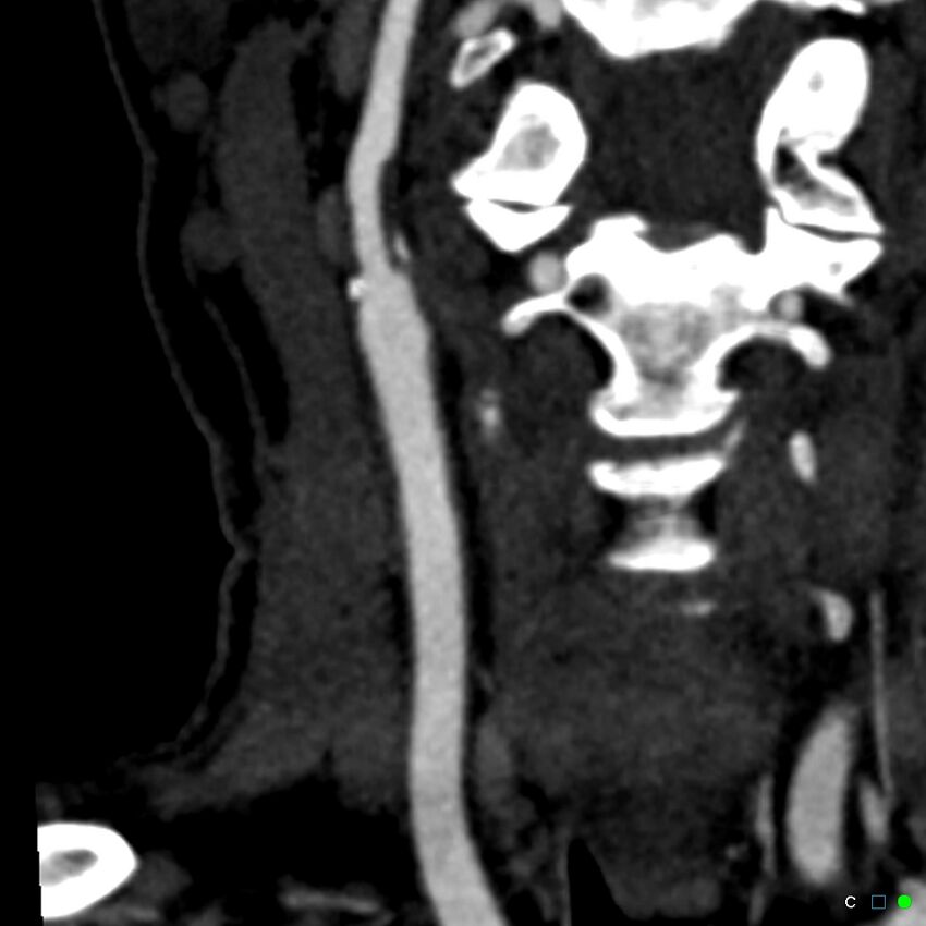 Non-occlusive intraluminal internal carotid artery thrombus (Radiopaedia 37751-39658 C 38).jpg
