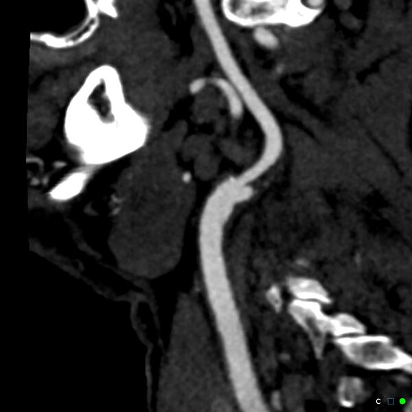 File:Non-occlusive intraluminal internal carotid artery thrombus (Radiopaedia 37751-39658 C 54).jpg