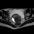 Non-puerperal uterine inversion (Radiopaedia 78343-90983 Axial T2 17).jpg