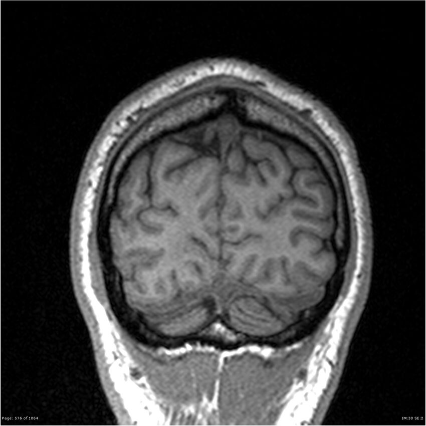Normal brain MRI (non-focal epilepsy protocol) (Radiopaedia 38571-40700 Coronal T1 14).jpg
