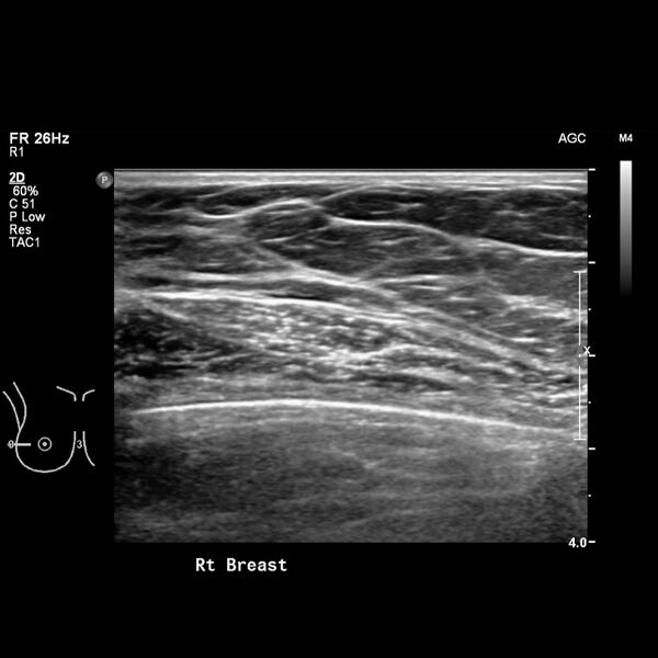 File:Normal breast mammography (tomosynthesis) and ultrasound (Radiopaedia 65325-74354 Right breast 10).jpeg