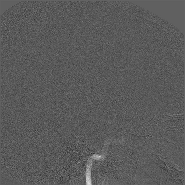 File:Normal cerebral angiogram (four vessel DSA) (Radiopaedia 41708-44649 F 6).png