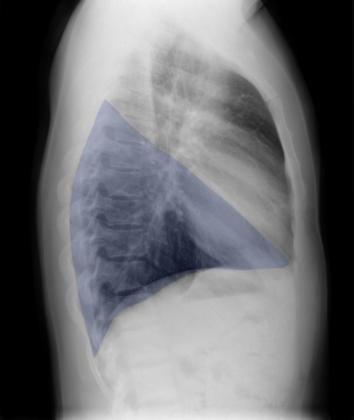 File:Normal chest x-ray - lobes (illustration) (Radiopaedia 58938-66192 G 1).png