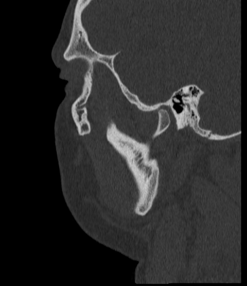 Normal facial bone CT (Radiopaedia 88742-105476 Sagittal bone window 132).jpg