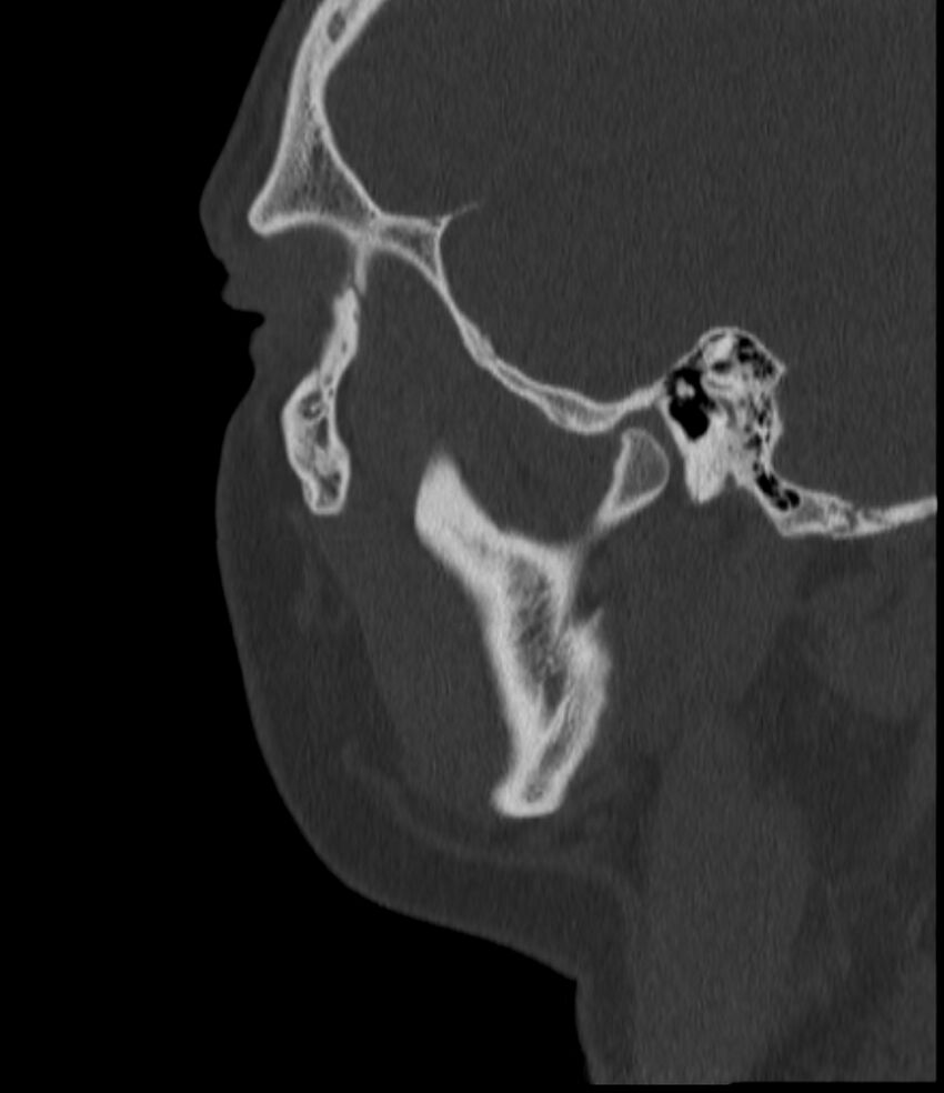 Normal facial bone CT (Radiopaedia 88742-105476 Sagittal bone window 41).jpg