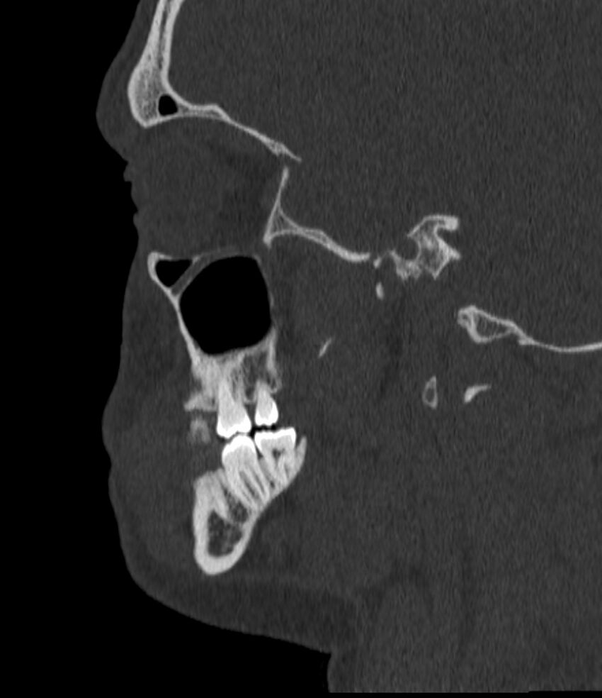 Normal facial bone CT (Radiopaedia 88742-105476 Sagittal bone window 58).jpg
